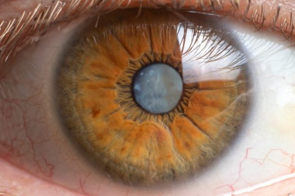 What are cataracts?